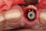 Figure 1  Implant placed directly into an extraction socket of a maxillary incisor.