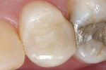 Figure 1  Large mesial-occlusal-distal restoration shown on tooth No. 13 at 6-month recall visit.