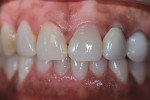 Figure 2  Patient concerns were a missing porcelain laminate on the maxillary right cuspid, composite material on the mesial corner of tooth No. 9, and mismatched color on tooth No. 8 caused by an endodontic fill. There were long-standing PFM crowns