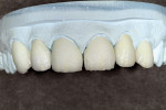 Figure 9  Basic dentin bleaching color was applied with a modifier.