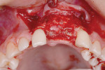 Fig 8. Graft of ridge is covered with resorbable collagen membrane prior to implant placement.