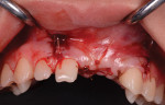 Fig 9. Buccal view of closure shows that normal volume is restored to the ridge.