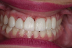 Fig 13. Provisional bridge and veneers are used to allow patient to comprehend the utilization of pink acrylic and veneers to achieve a more ideal pink/white ratio.