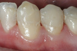 Figure 6  The mandibular canine and first premolar were restored with a nano-hybrid composite resin (N’Durance).