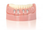 Figure 1  A minimum of four implants placed 5 mm apart are required to stabilize a full lower denture.