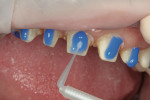 Figure 3  Etchant was placed on the prepared teeth.
