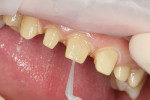 Figure 4  OptiBond Solo Plus was applied, air-thinned, and cured for 5 seconds on each tooth.