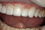 Figure 5  The veneers were seated with resin cement (NX3).