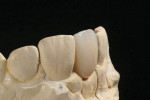 Cement-retained implant crown on a stone model.