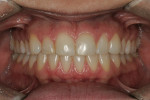 Figure 11  After internal bleaching and before external whitening.