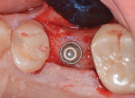 Fig 6. Implant placement at the level of crestal bone, with primary stability.