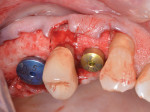 Fig 13. A dermal allograft was used for its barrier function and ability to increase the thickness of the peri-implant mucosa.