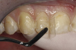 Figure 5  The first layer of Filtek Supreme Ultra Universal restorative in dentin shade A3D was applied.