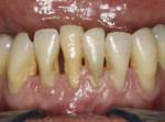 Figure 7   Preoperative clinical photograph of hopelessly involved symptomatic teeth.