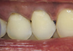Figure 6   Simplifying Class 5 techniques with one to three layering applications of A3 F03 to create lifelike restorations.
