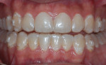 Fig 1. Case 1. Patient before bleaching with clear aligner trays in place.