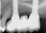 Figure 2  This radiograph was taken exactly 2 years after implant placement. Note the bone stability and radiodensity of the bone around both fixtures, which were placed into bone regenerated in areas grafted with a radiolucent graft material (rhBMP-