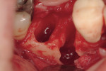 Figure 3  Advanced bone loss is evident after extraction of tooth No. 30. Only a crestal bridge remains from the interradicular septum due to advanced infection. The socket was debrided of all soft-tissue remnants with ultrasonic and hand instruments