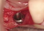 Figure 4  At about 3.5 months after extraction and grafting with rhBMP-2/ACS, excellent regeneration had occurred, facilitating standardized implant placement with primary stability.