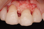 Figure 6  Mineralized bone allograft (OraGraft) was hydrated with rhPDGF-BB solution at 0.3 mg/ml for over 10 minutes, and was then placed into the osseous defect and over the instrumented root surface of tooth No. 9. The graft was then covered with