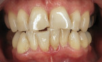 Pretreatment retracted smile photograph, demonstrating how the lower anterior teeth had worn and chipped the opposing upper anterior teeth.