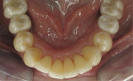 Four-year postoperative mandibular occlusal view of the aligned lower teeth with crowns in place.