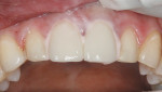 Figure 7  Central veneers with pink opaque try-in paste.