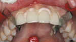 Figure 8  Veneers seated; pink opaque cement on the centrals and YRU on the laterals.