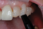 Fig 8. Light-cure-only cement was applied to the teeth, veneers were placed, clean-up was completed, and light-curing was done.