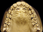Figure 7  Moderate NCLTS from toothpaste, maxillary arch.