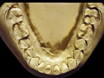 Figure 12  Advanced NCLTS from toothpaste, mandibular arch.
