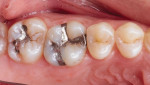 Pretreatment image of failed amalgam restorations on teeth Nos. 14 and 15.