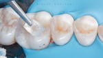 A protective barrier is applied to the finished composite restorations.