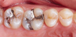 Side-by-side comparison of the pretreatment failed amalgam restorations and the final polished composite restorations.