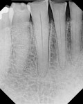 Figure 2  Completely worn out lower anterior teeth resulted in a loss of vertical dimension. Tooth No. 23 was necrotic with a chronic apical lesion.