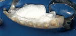 Figure 3  Completely worn out lower anterior teeth resulted in a loss of vertical dimension. Tooth No. 23 was necrotic with a chronic apical lesion.
