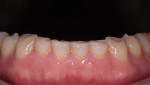 Fig 3. Mandibular incisors show attrition and erosion.