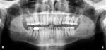 Fig 4. The preoperative panoramic radiograph shows no evidence of periodontal disease.