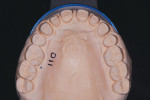 Fig 9. The maxillary model of prepared teeth shows conservative posterior adhesive and anterior cohesive tooth preparations.