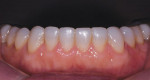 Fig 13. A postoperative view shows restoration of mandibular erosion, blending of composite to natural teeth, and leveling of the mandibular plane.