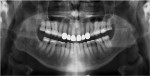 Fig 17. Postoperative panoramic radiograph shows no interproximal reduction on maxillary posterior teeth and radiopaque maxillary anterior zirconia restorations.