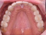 Fig 18. Maxillary restorations are seated with deprogrammer in place to achieve bilateral simultaneous occlusion.