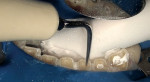 Figure 14  After condensation, an ultrasonic tip with water was used to remove the sealer smeared on the canal walls. Touching the gutta-percha with the ultrasonic tip should be avoided in order not to disturb the apical seal.