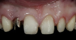 Figure 14  Patient shown 1 week postoperatively, prior to insertion of the final restorations.