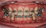 Fig 9. Power arms used for retraction of mandibular incisors.
