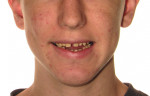 Fig 10. Pre- and
post-treatment smile comparison. The treatment achieved a significant occlusal change and smile makeover. Additionally, the
patient’s profile appearance (not shown) was improved from the use of the aligners, decreasing the vertical jaw relationship
and contributing to the autorotation of the mandible, thus eliminating the need for orthognathic surgery. (Restorative dentistry:
Gregory E. Morgan, DDS, Fresno, California) Before doing additional restorative work, refinement aligners can be used to
address the maxillary diastema due to the incisive frenum attachment, and posterior occlusal preparation can be performed
before completion of the full-mouth rehabilitation.