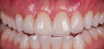 Fig 5. A provisional, or trial smile, allows the patient and restorative team to agree on the approach to the case.