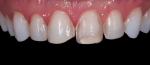 Fig 6. Minimally invasive preparation was performed by Maria Paranhos, DDS.