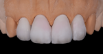 Fig 14. A second skin layer is added for morphology correction as well as to create a halo effect on the incisal edge.