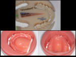 Fig 4. Milling a denture base and teeth from PMMA results in an esthetic option with premium strength.